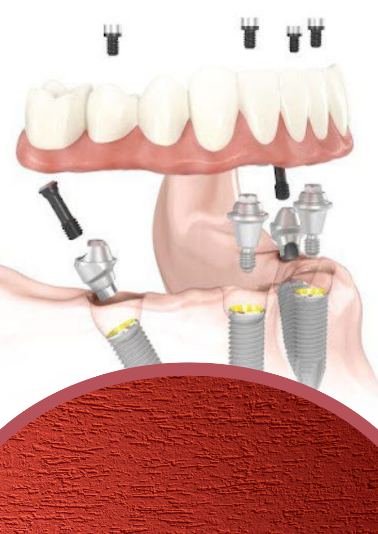 All On 4 Dental Implants