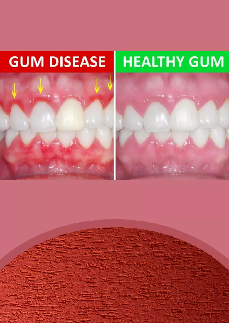 Gum Diseases
